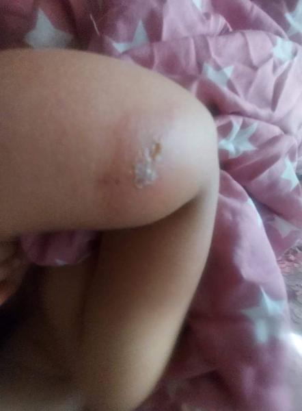 Aký kožný problém má môj synovec?