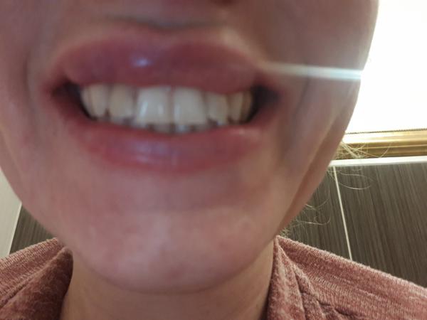 Prečo mám hrčky po výplni pier?