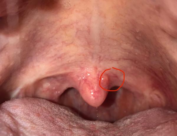 Čo znamená hrčka na podnebnom čapíku?