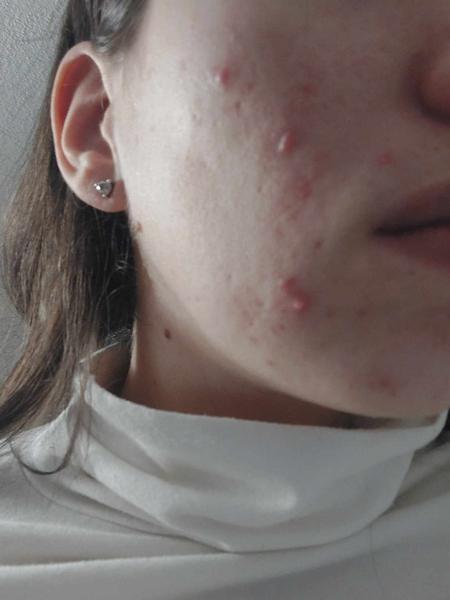 Je silné akné dôsledkom intolerancie na potraviny?