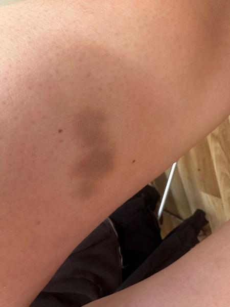 Čo môže spôsobovať modriny z ničoho nič?