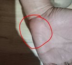 Bolesť dlane: Čo môže byť príčinou?