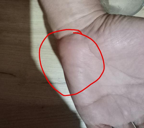 Bolesť dlane: Čo môže byť príčinou?