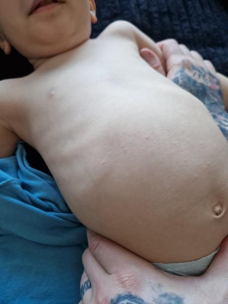 Čo spôsobilo vyrážky u 22-mesačného syna?