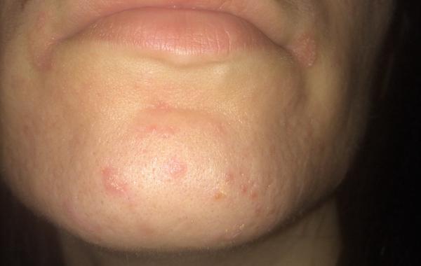 Ekzém pri kútikoch a na brade - s čím to môže súvisieť?