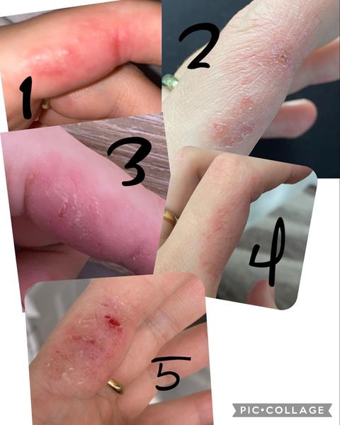 Je toto naozaj ekzém?