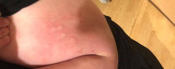 Od čoho sú tieto vyrážky?