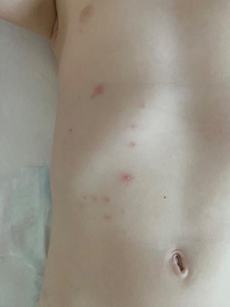 Čo spôsobuje zapálené vyrážky na hrudi u detí?