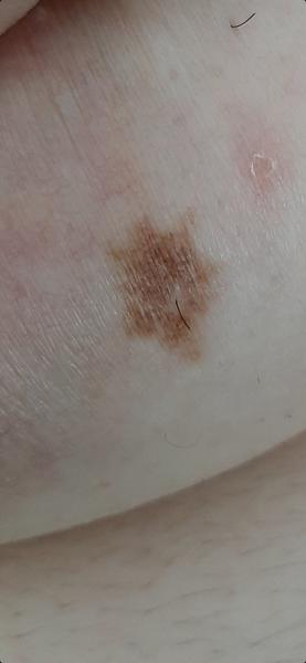 Sú moje znamienka nebezpečné?