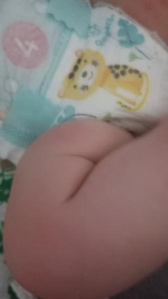 Červené vyrážky u bábätka: Čo robiť?