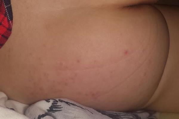 Vyrážky na zadočku a stehne