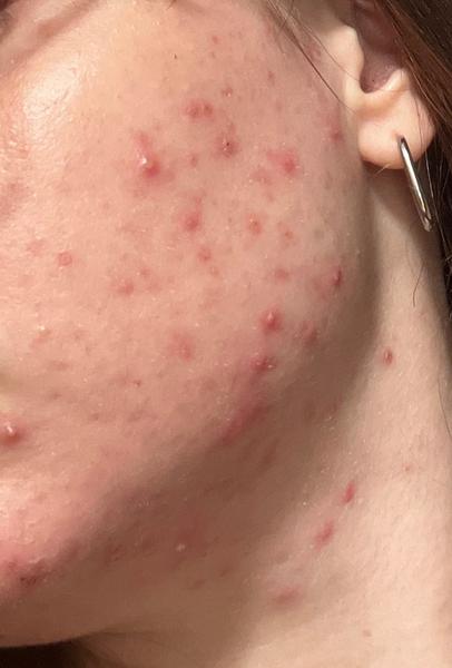 Ako riešiť problematickú pleť?