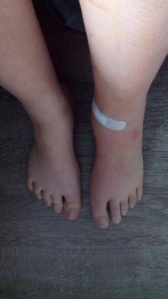 Operácia kŕčových žíl laserom