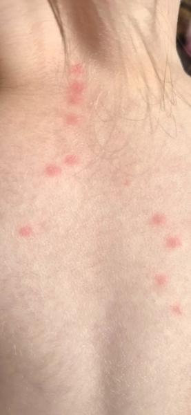 Sú to štipance u ročnej dcérky?