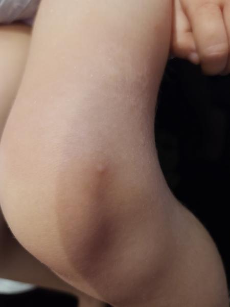 Máte skúsenosti s uštipnutím mačacou blchou?