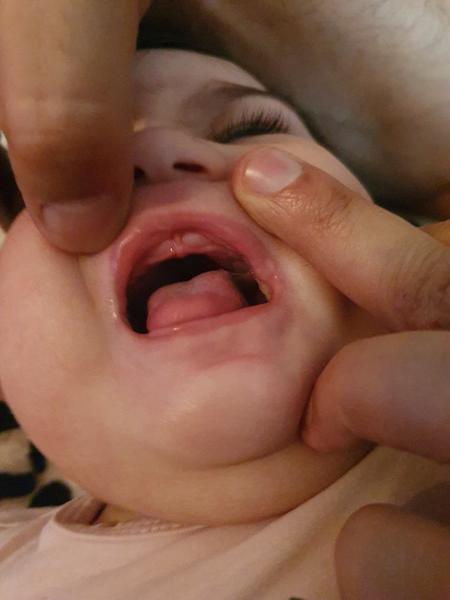 Je dcérka nespokojná kvôli zúbkom?