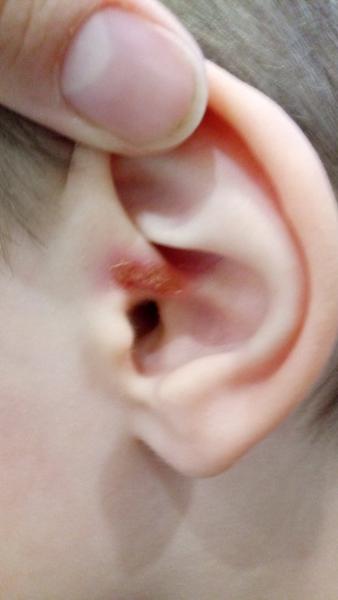 Čo to je? Herpes alebo vírus?