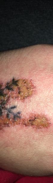 Mám hnisavú ranu na tetovaní?