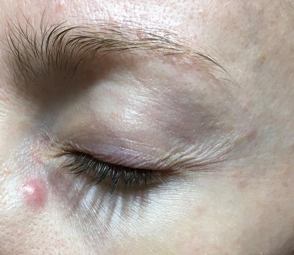 Mám kvôli hrčke pod okom navštíviť dermatológa alebo očného lekára?