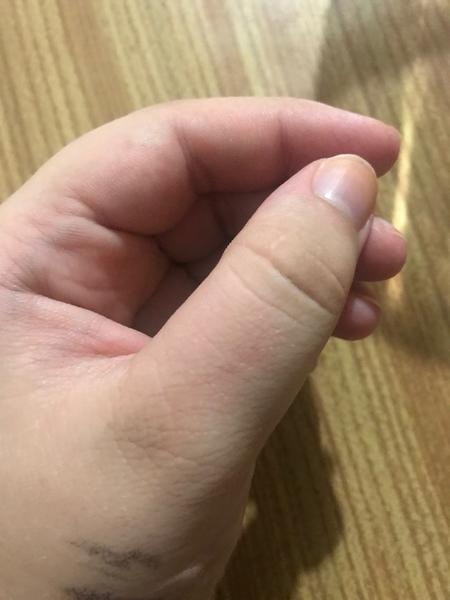 Prečo mám opuchnutý palec?