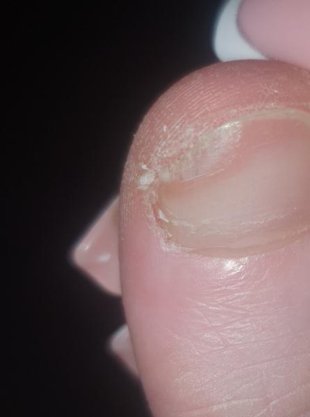 Problém s nechtom u dcérky