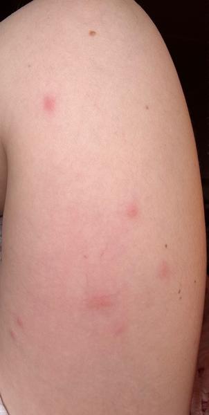 Ako rozpoznať štípanec od ploštice?