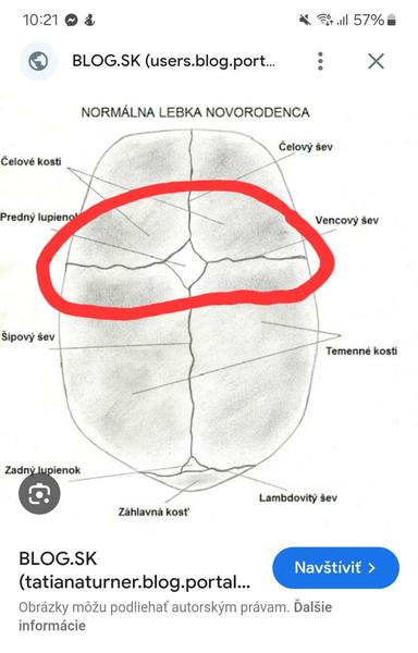 Je viditeľný lebečný šev u detí normálny?