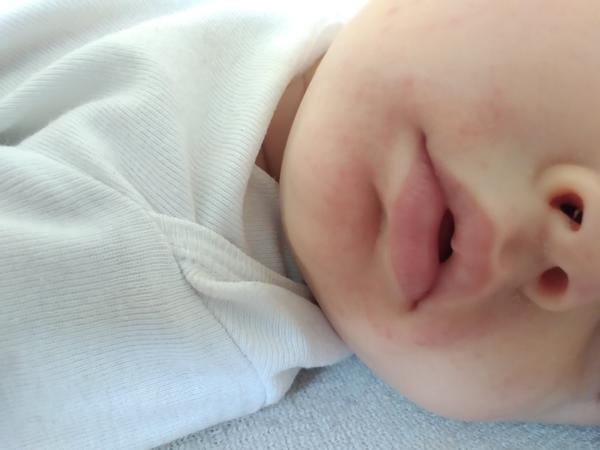 Prečo sa 10 mesačnému synovi tvoria červené bodky okolo úst?