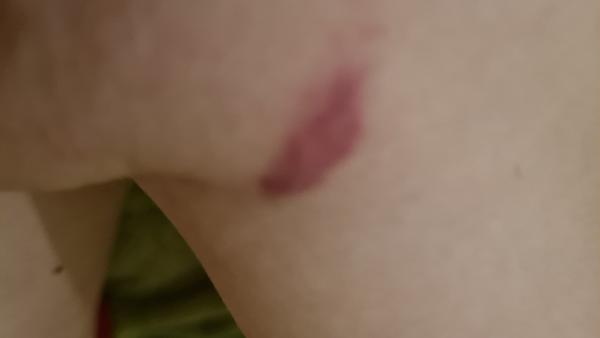 Na ruke sa mi vyhodil fialový fľak