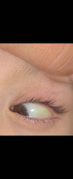 Má toto oko príznaky žltačky?