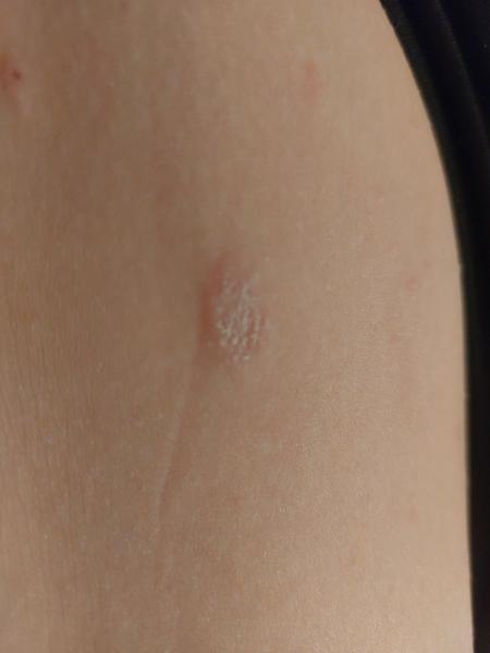 Akú to mám vyrážku?