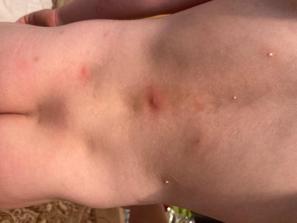 Stretli ste sa už s takýmito vyrážkami?