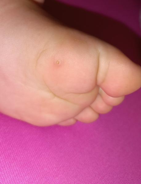 Je to kurie oko alebo bradavica?