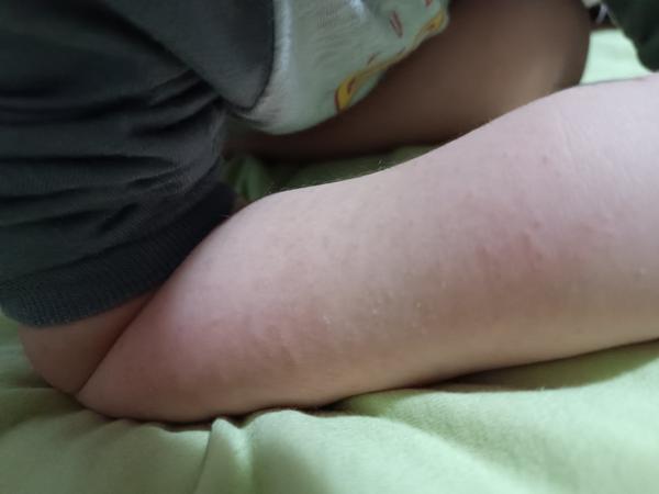 Môže potravinová alergia spôsobiť vyrážky bez svrbenia?