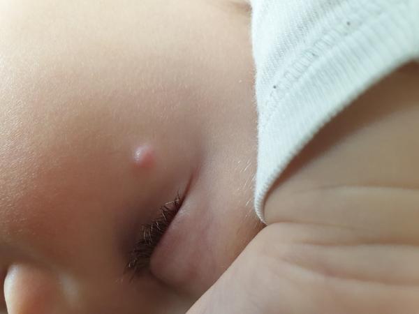 20 mesačný synček má pod okom už tri mesiace vyrážku. O aký problém ide?