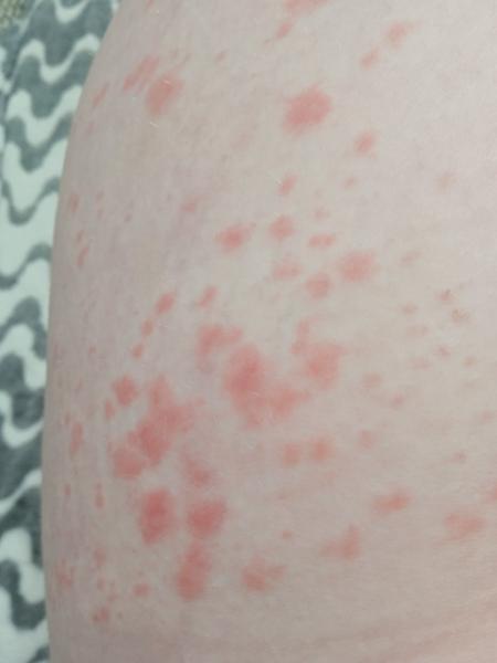 Červené vyrážky na stehnách z vonkajšej strany