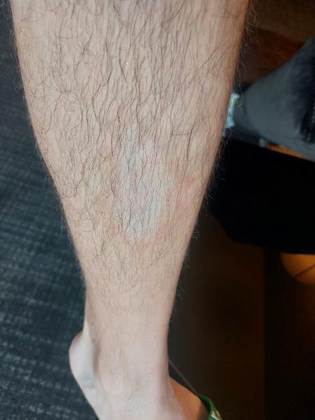 Čo znamená biele svetlé miesto na nohe?