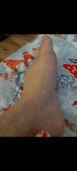 Čo sa mi vytvorilo na chodidle?