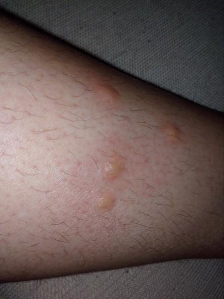 Čo to je za štípance?