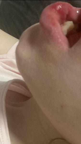 Mám afty alebo ísť k zubárovi?