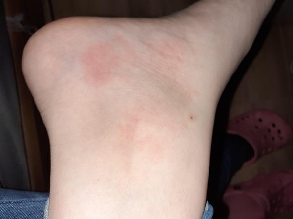 Dcéru poštípal asi ovad