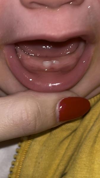 Čo spôsobuje vyrážku na ďasnách?