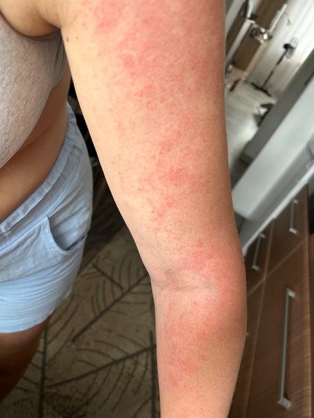 Po pôrode som sa vyhádzala. Môže sa takto prejavovať alergia?