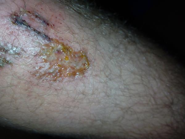 Poraďte mi prosim, čo s poraneným kolenom