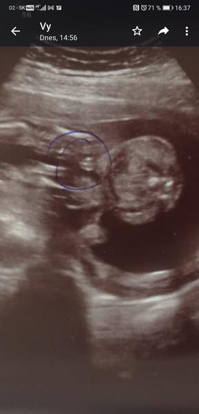 Aké je pohlavie dieťatka?