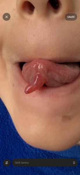 Výrastok na jazyku: Čo to môže byť?