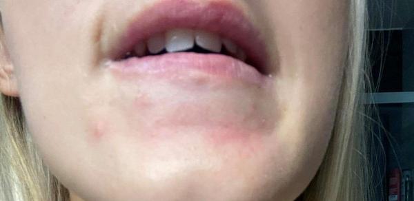 Začervenanie na brade a hrbolčeky