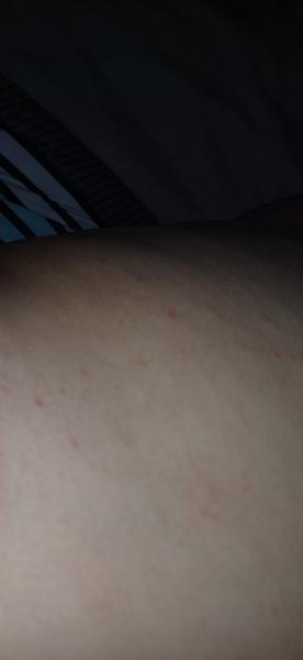 Čo spôsobuje červené bodky po tele?