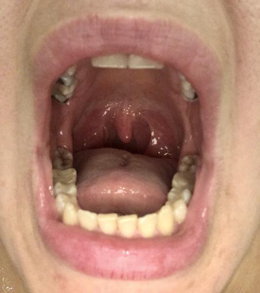 Prečo mám žilky v hrdle?