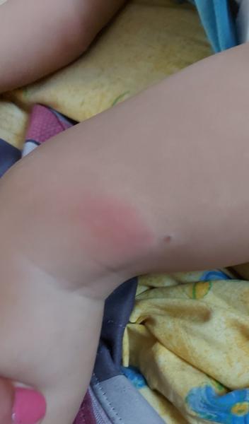 Čo spôsobil vyrážky na tvári, rukách a nohách?